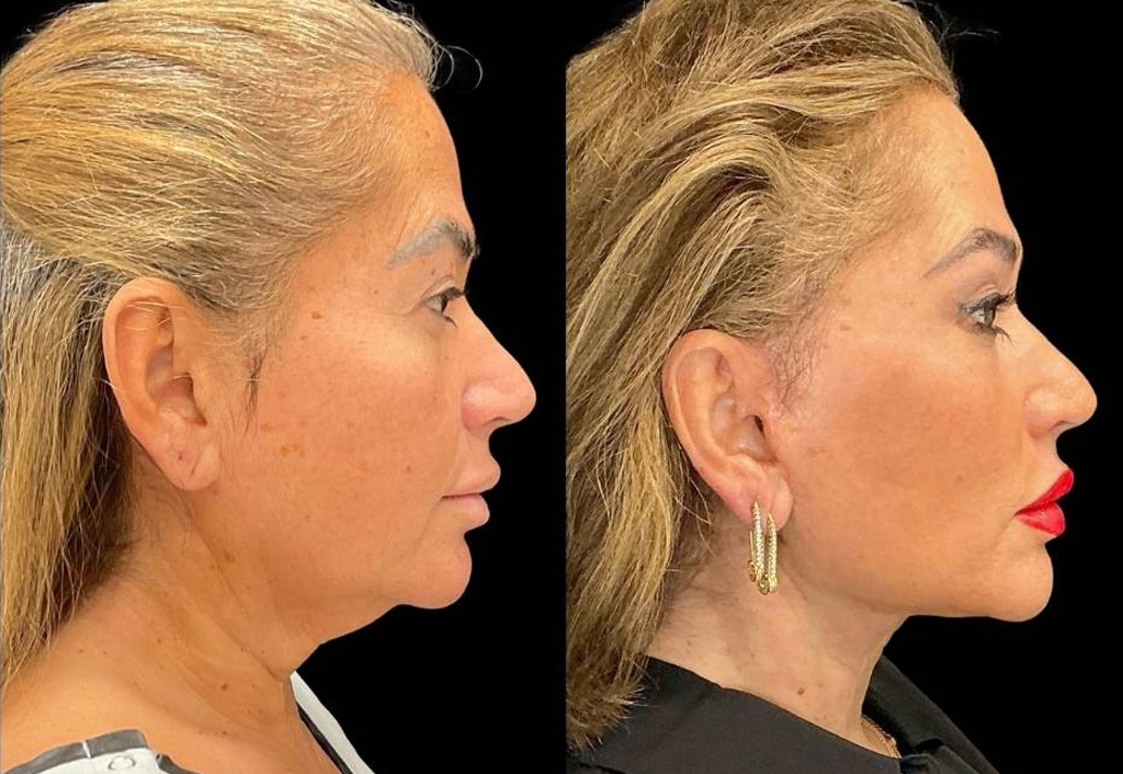 62-yr-old-female-facelift-before-and-after-right-view.jpg