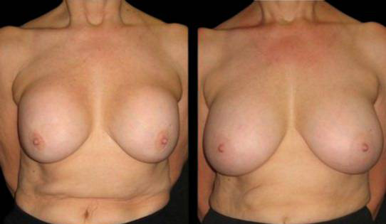 63-year-old-female-breast-implant-exchange-before-and-after-front-view.jpg