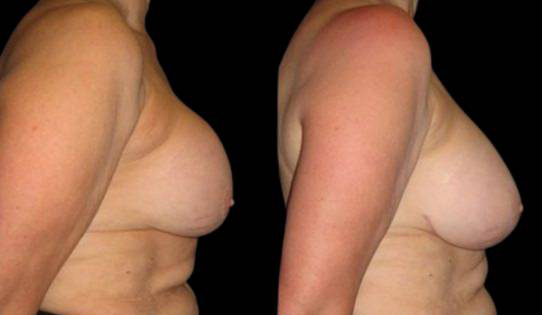 63-year-old-female-breast-implant-exchange-before-and-after-side-view.jpg
