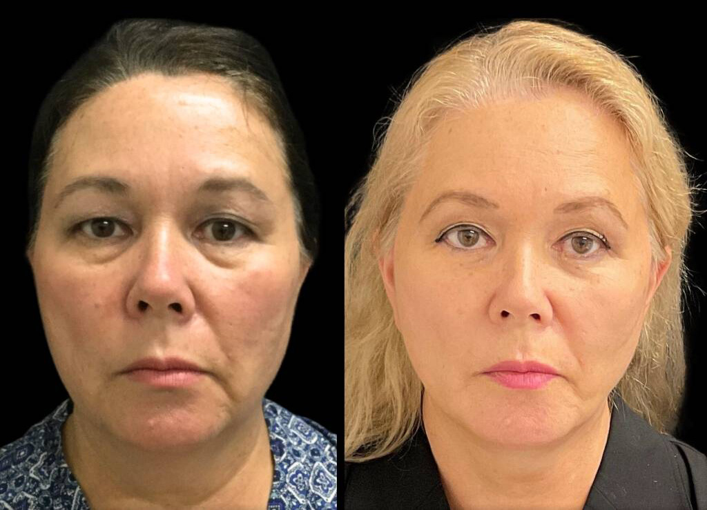 63-year-old-female-facelift-before-and-after-front-view.jpg