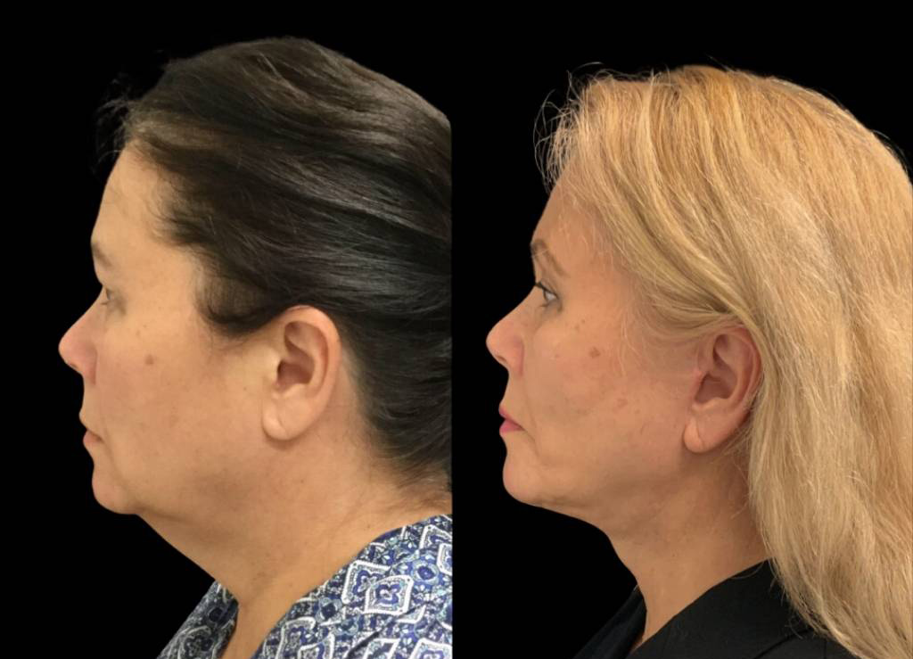 63-year-old-female-facelift-before-and-after-side-view-24811.jpg