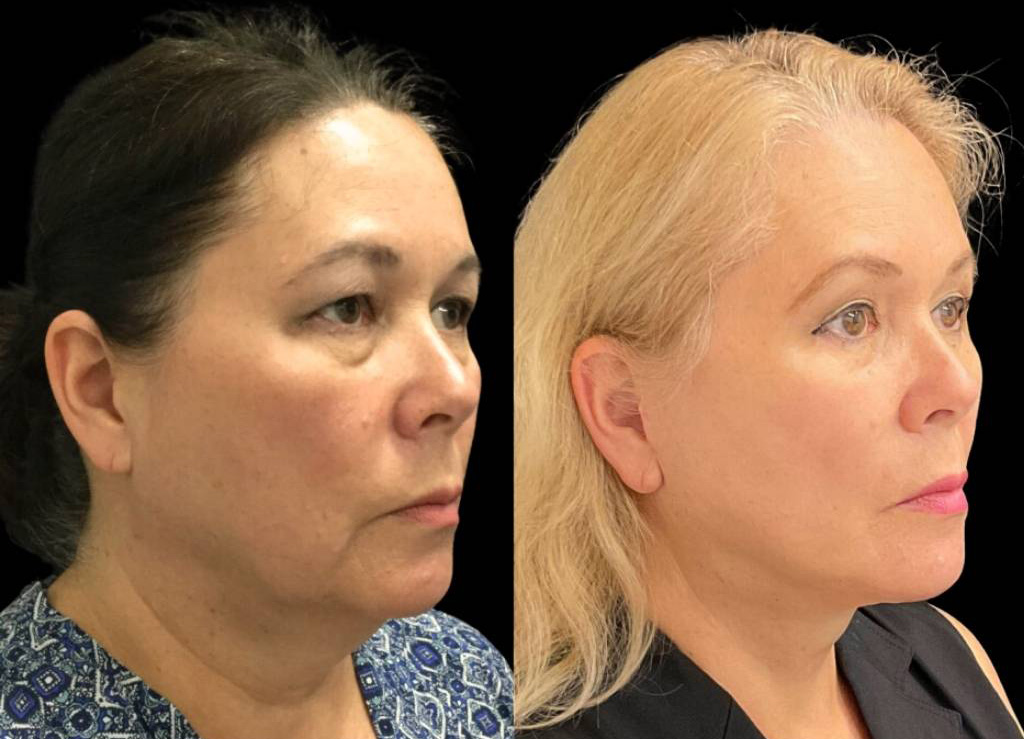 63-year-old-female-facelift-before-and-after-three-quarter-view-2.jpg