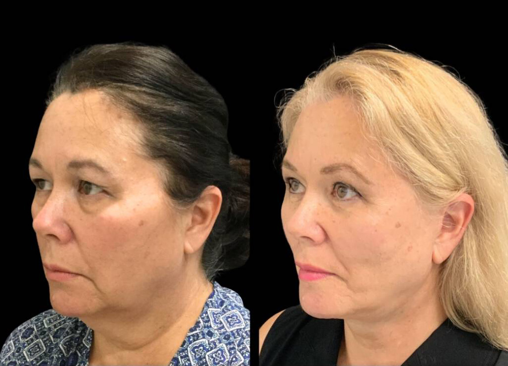 63-year-old-female-facelift-before-and-after-three-quarter-view.jpg