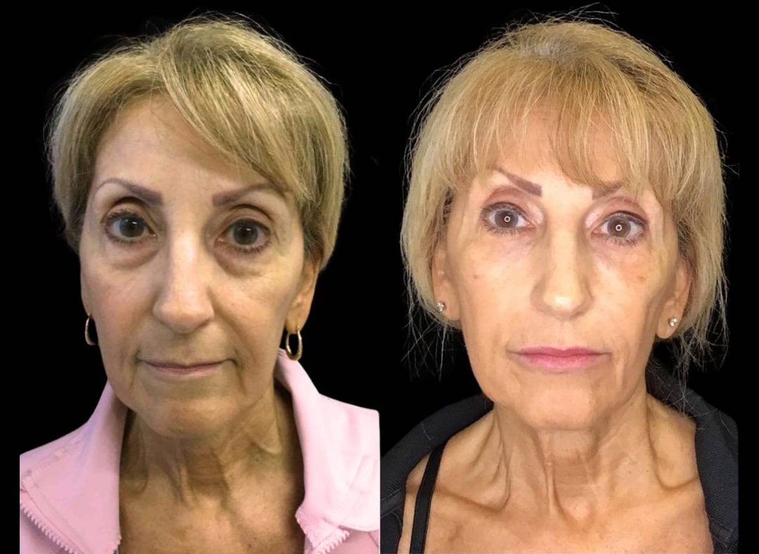 63-year-old-female-model-lift-before-and-after-front-view-29379.jpg