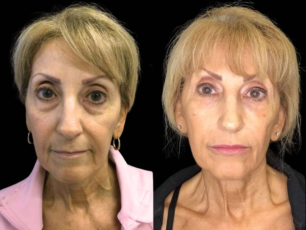 63-year-old-female-model-lift-before-and-after-front-view-29379.jpg