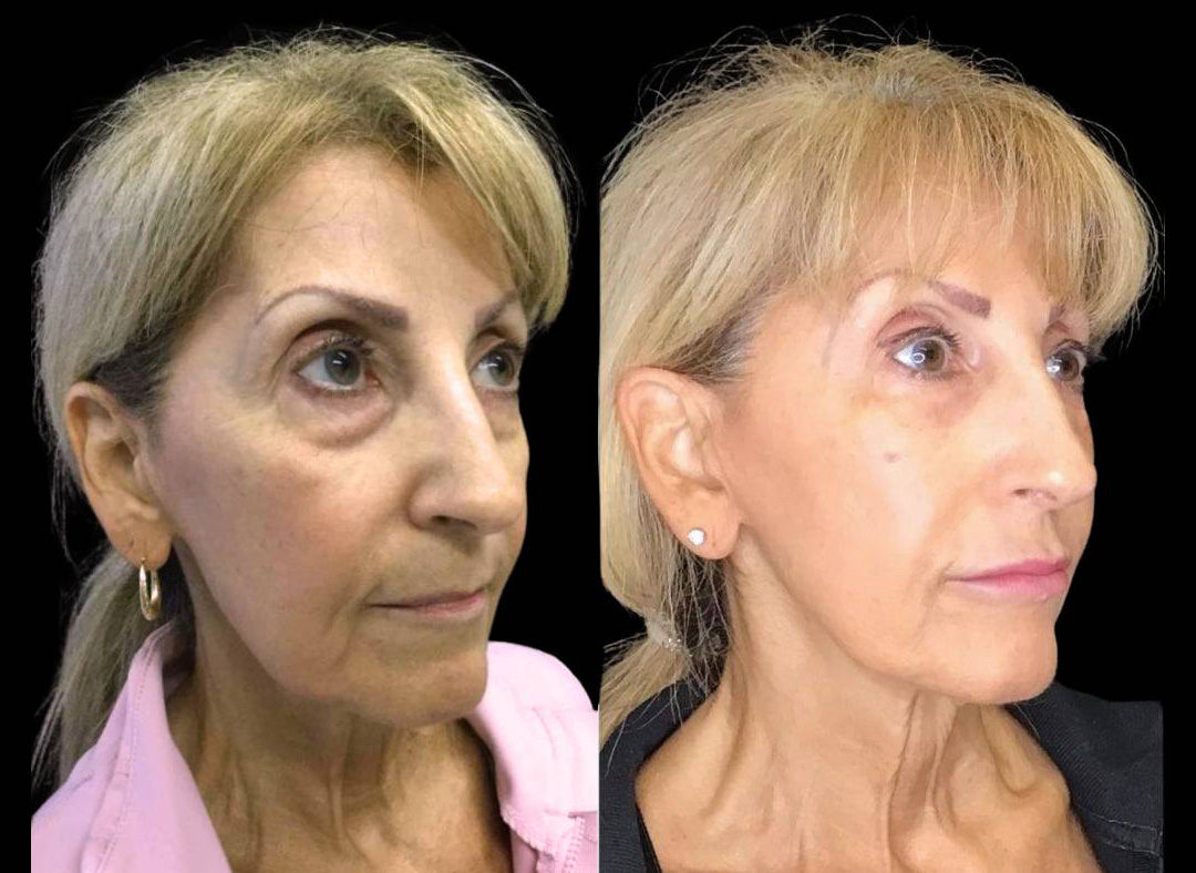 63-year-old-female-model-lift-before-and-after-three-quarter-view.jpg