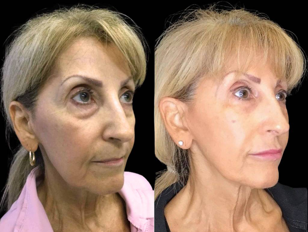 63-year-old-female-model-lift-before-and-after-three-quarter-view.jpg