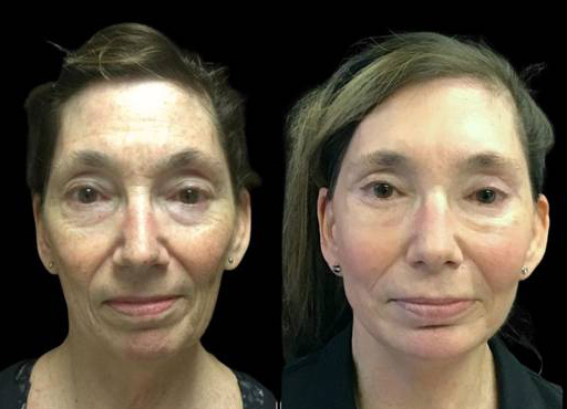 63-year-old-female-upper-and-lower-eyelid-lift-before-and-after-front-view-26972.jpg