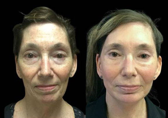 63-year-old-female-upper-and-lower-eyelid-lift-before-and-after-front-view-26972.jpg