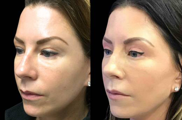 63-year-old-female-upper-and-lower-eyelid-lift-before-and-after-front-view-26972.jpg
