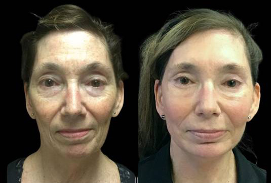63-year-old-female-upper-and-lower-eyelid-lift-before-and-after-front-view-26972.jpg