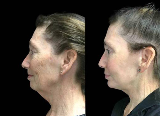 63-year-old-female-upper-and-lower-eyelid-lift-before-and-after-side-view.jpg
