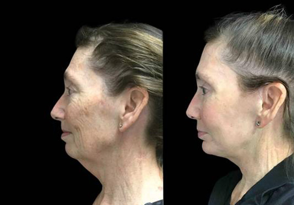 63-year-old-female-upper-and-lower-eyelid-lift-before-and-after-side-view.jpg
