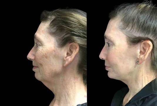 63-year-old-female-upper-and-lower-eyelid-lift-before-and-after-side-view.jpg