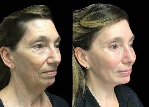 63-year-old-female-upper-and-lower-eyelid-lift-before-and-after-three-quarter-view.jpg