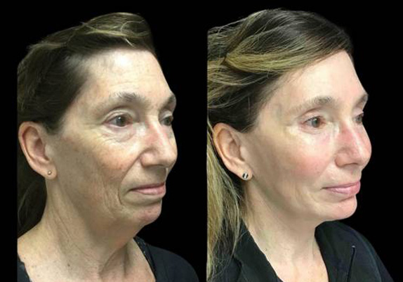 63-year-old-female-upper-and-lower-eyelid-lift-before-and-after-three-quarter-view.jpg