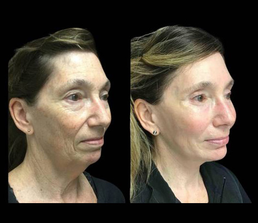 63-year-old-female-upper-and-lower-eyelid-lift-before-and-after-three-quarter-view