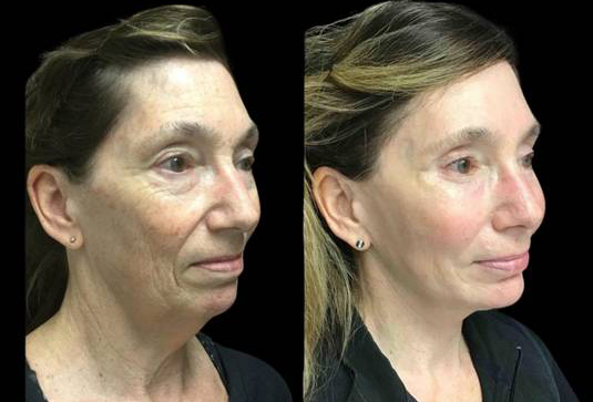 63-year-old-female-upper-and-lower-eyelid-lift-before-and-after-three-quarter-view.jpg