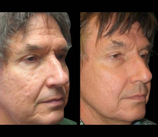 63-year-old-male-fractional-co2-laser-treatment-before-and-after-three-quarters-view