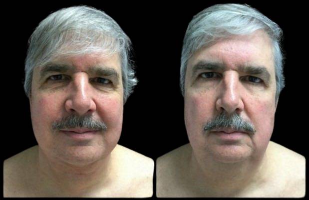 63-year-old-male-mini-facelift-before-and-after-front-view