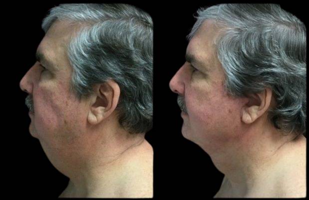 63-year-old-male-mini-facelift-before-and-after-side-view