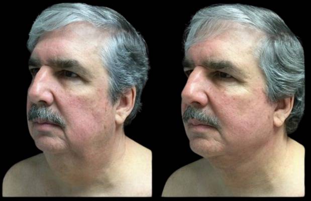 63-year-old-male-mini-facelift-before-and-after-three-quarter-view