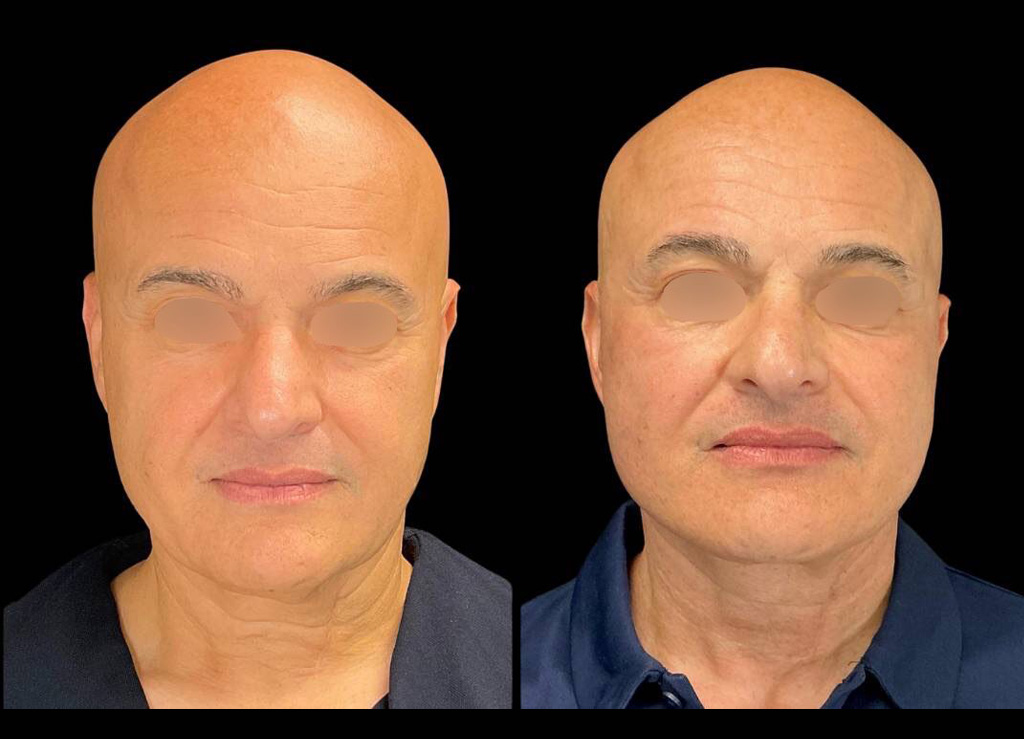 63-yr-old-male-facelift-before-and-after-front-view.jpeg