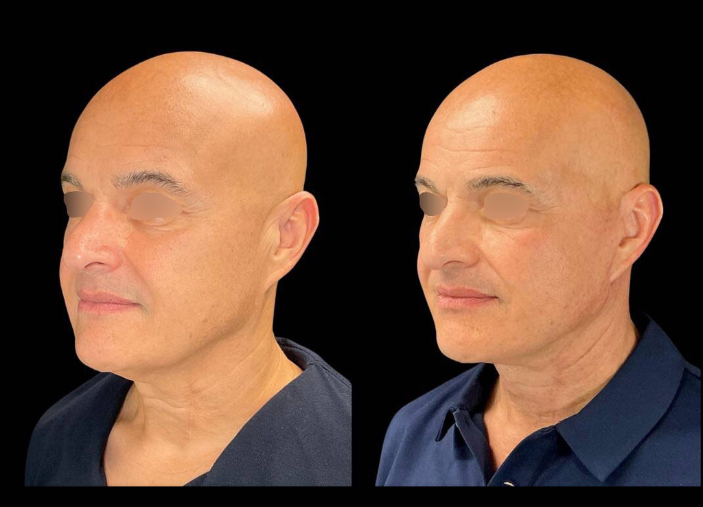 63-yr-old-male-facelift-before-and-after-left-three-quarter-view.jpeg
