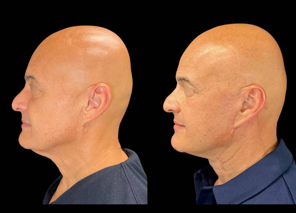 63-yr-old-male-facelift-before-and-after-left-view.jpeg
