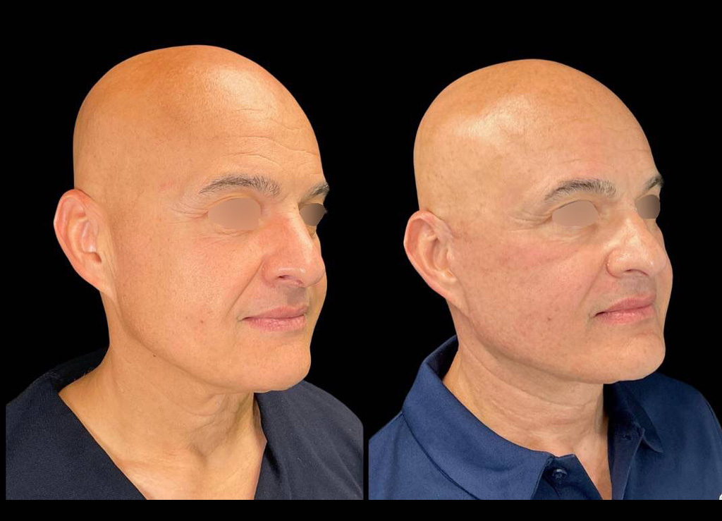 63-yr-old-male-facelift-before-and-after-right-three-quarter-view.jpeg