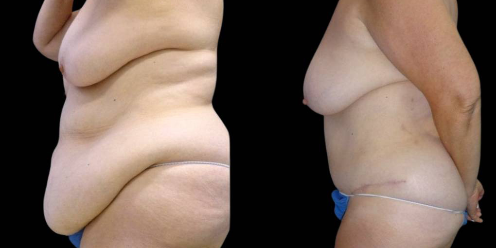 This is a 64-year-old female that has had a tummy tuck and liposuction done after weight loss showing the before and after's side-by-side