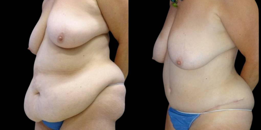 This is a 64-year-old female that has had a tummy tuck and liposuction done after weight loss showing the before and after's side-by-side