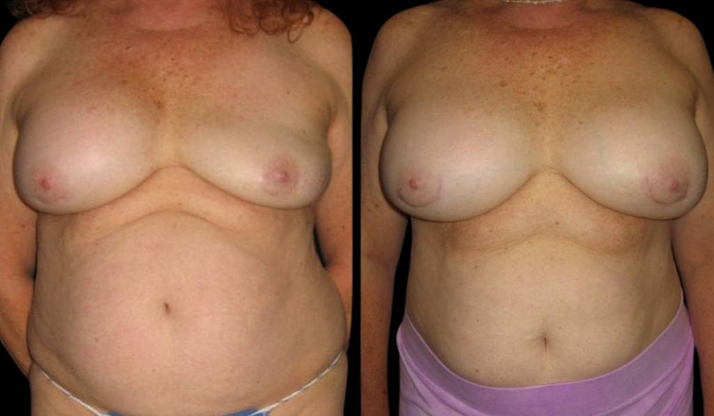 64-year-old-female-breast-implant-exchange-before-and-after-front-view-1276.jpg