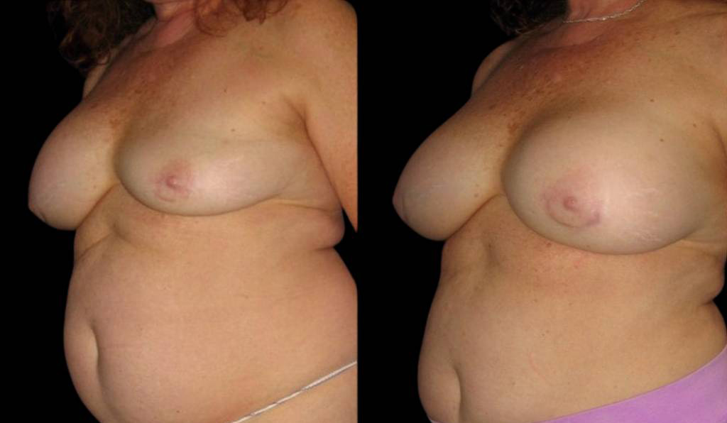 64-year-old-female-breast-implant-exchange-before-and-after-three-quarter-view.jpg