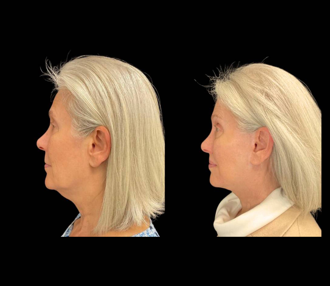 64-year-old-female-lower-lip-lift-before-and-after-side-view.jpg