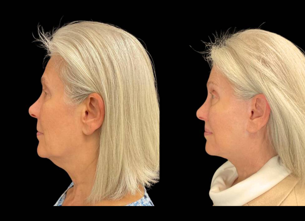 64-year-old-female-lower-lip-lift-before-and-after-side-view.jpg