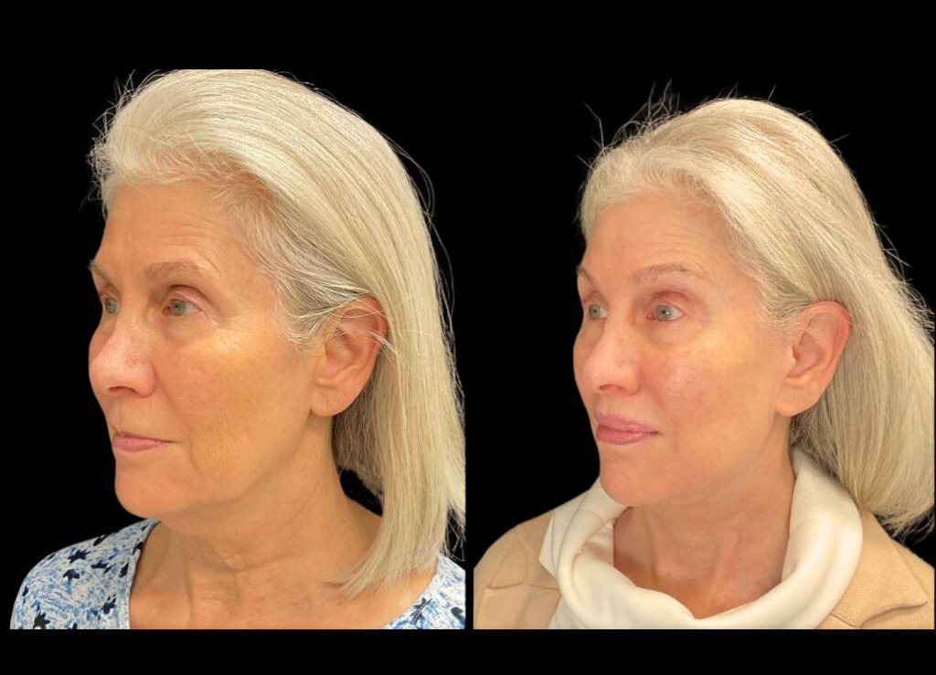 64-year-old-female-lower-lip-lift-before-and-after-three-quarter-view.jpg