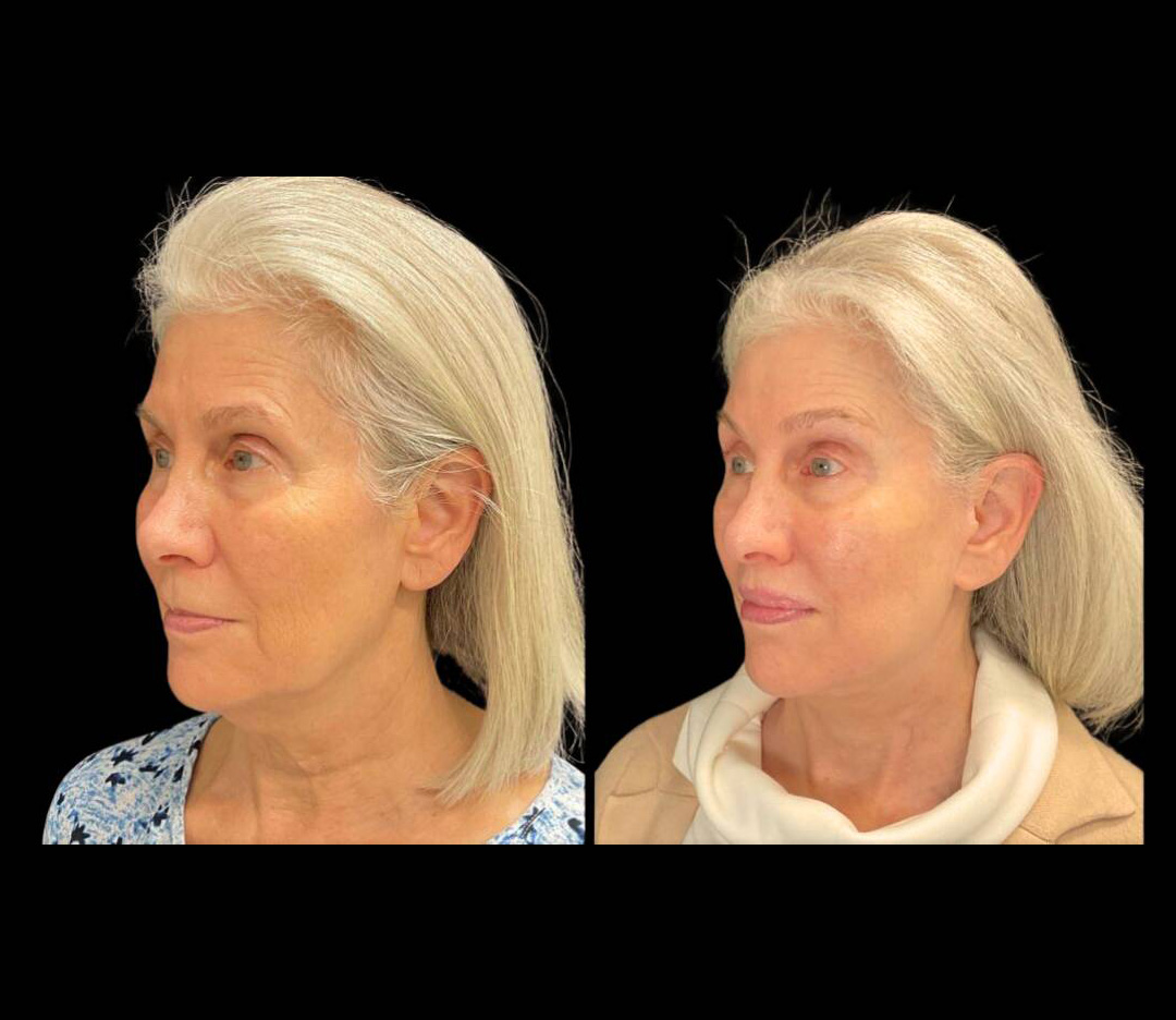 64-year-old-female-lower-lip-lift-before-and-after-three-quarter-view.jpg