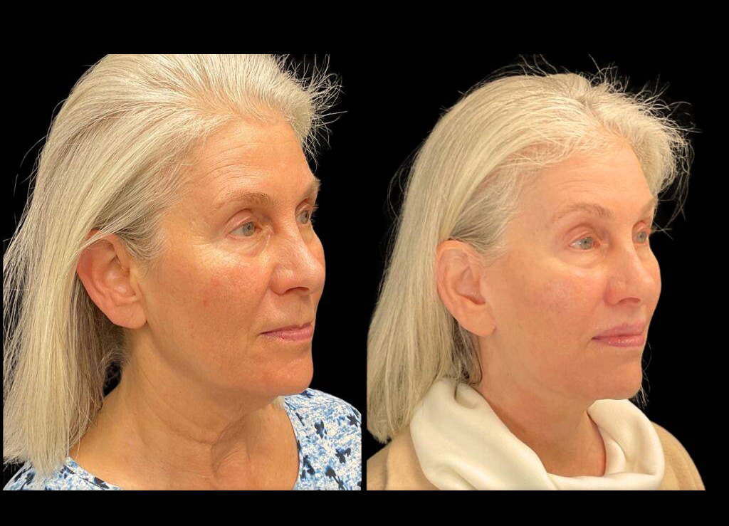 64-year-old-female-lower-lip-lift-before-and-after-three-quarter-view-35917.jpg