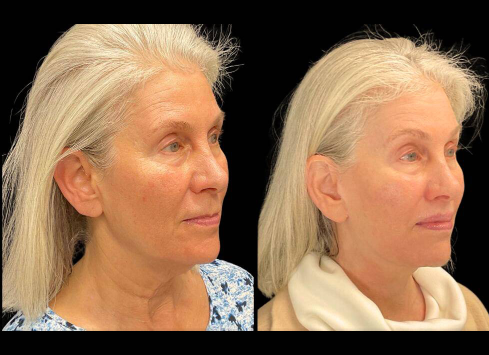 64-year-old-female-lower-lip-lift-before-and-after-three-quarter-view-35917.jpg
