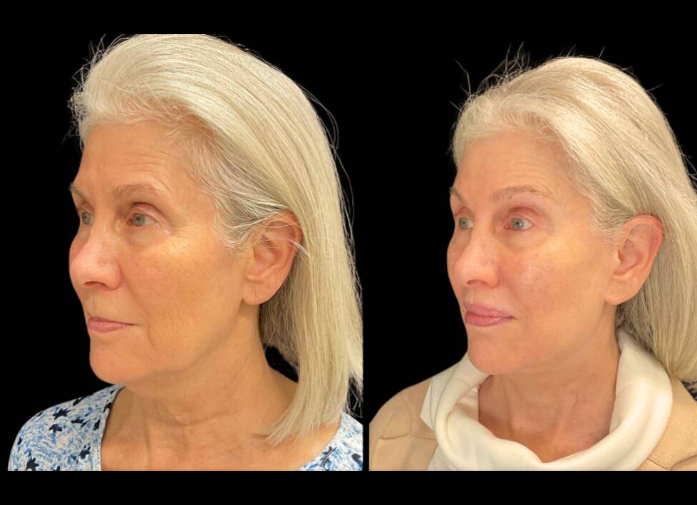 64-year-old-female-lower-lip-lift-before-and-after-three-quarter-view.jpg