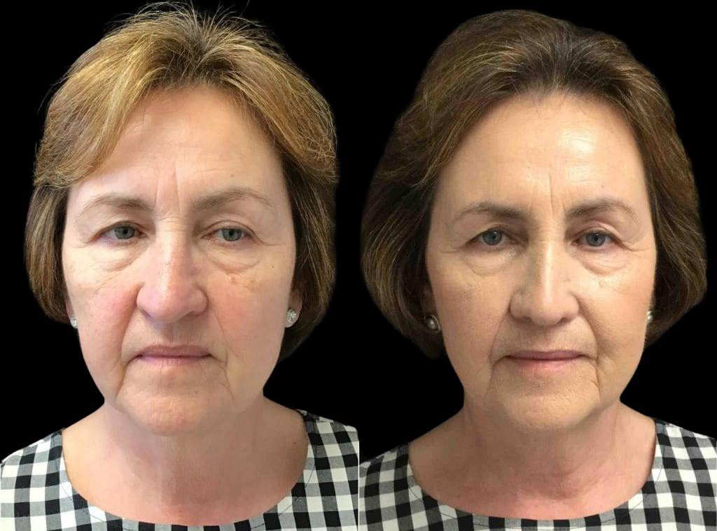 64-year-old-female-rhinoplasty-before-and-after-front-view-.jpg