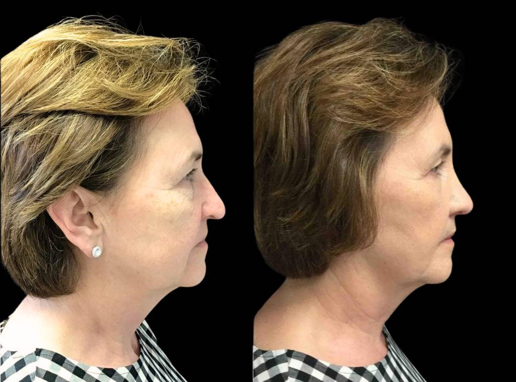 64-year-old-female-rhinoplasty-before-and-after-side-view-.jpg
