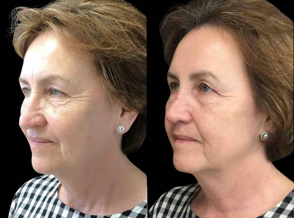 64-year-old-female-rhinoplasty-before-and-after-three-quarters-view-.jpg