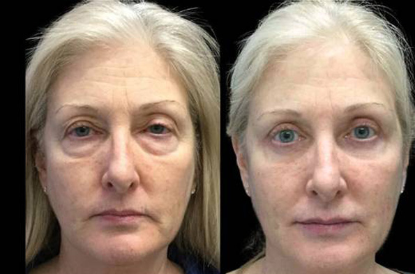 64-year-old-female-upper-and-lower-eyelid-lift-before-and-after-front-view.jpg