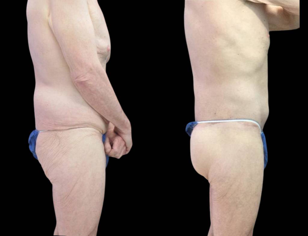 64-year-old-male-butt-augmentation-before-and-after-side-view-.jpg