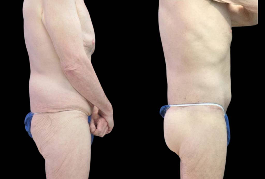 64-year-old-male-butt-augmentation-before-and-after-side-view-.jpg
