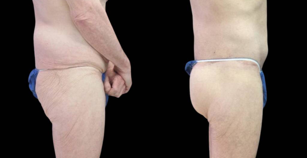 64-year-old-male-butt-augmentation-before-and-after-side-view-.jpg