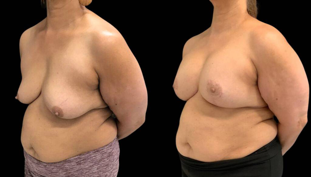 65-year-old-female-breast-lift-with-augmentation-before-and-after-three-quarter-view.jpg