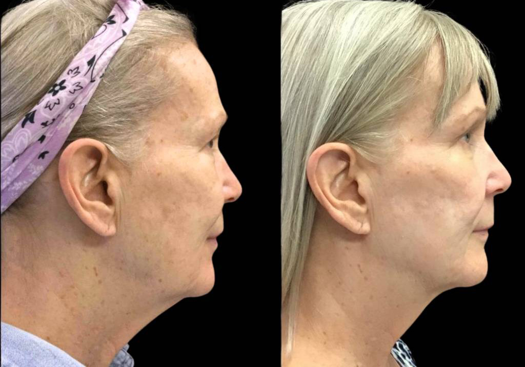 65-year-old-female-kybella-before-and-after-1.jpg